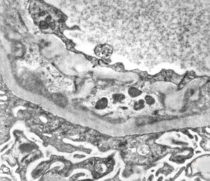 F,47y. | IgA nephropathy (Berger disease)